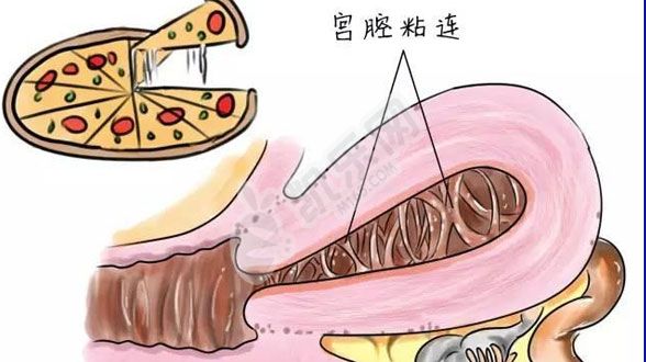 宫腔粘连试管成功率多大?权威解读(图3)