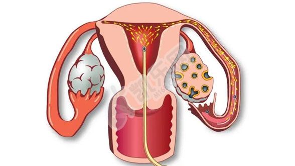 宫腔粘连试管成功率多大?权威解读(图4)