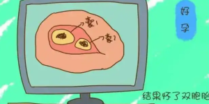多囊促排怀双胞胎经验分享，附注意事项汇总