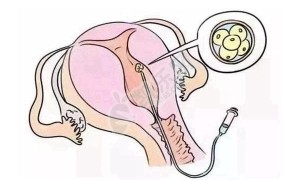 高龄女性做供卵试管能成功吗 主要看这几点